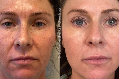 coolpeel before and after